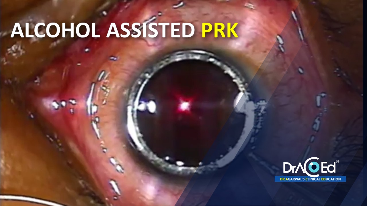 ALCOHOL ASSISTED PRK